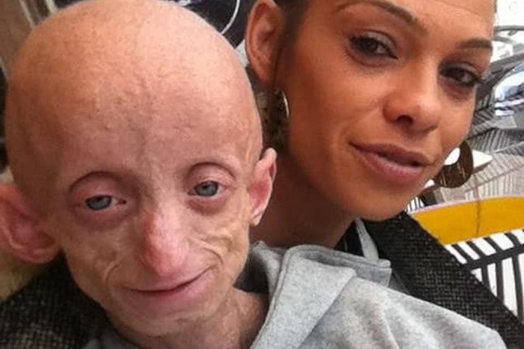 Benjamin Button Malattia Benjamin Button Malattia